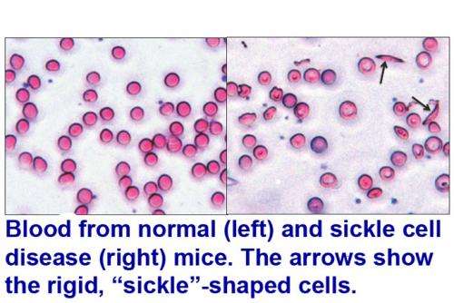 Could an old antidepressant treat sickle cell disease?