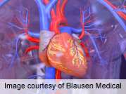 发布了稳定缺血性心脏病的检测标准