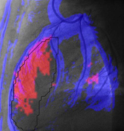 Design of a new tool to improve and speed up diagnosis of heart damage after a heart attack