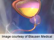 Detection bias may explain raised bladder CA risk in T2DM
