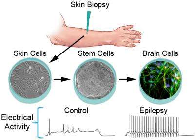 Epilepsy in a dish: Stem cell research reveals clues to disease's origins and possible treatment