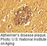 FDA wants to relax approval process for alzheimer's drugs