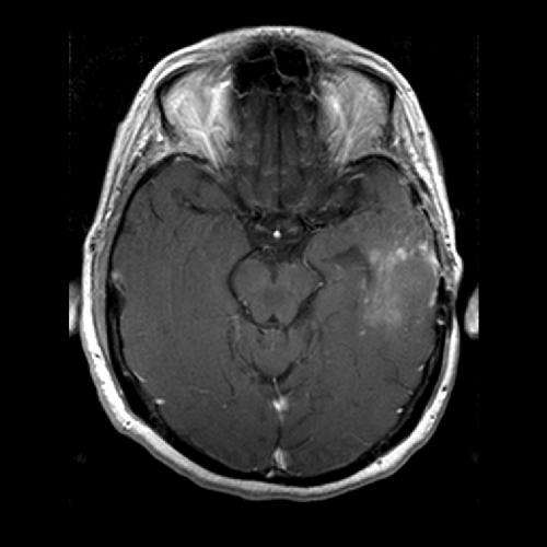 New MR analysis technique reveals brain tumor response to anti-angiogenesis therapy