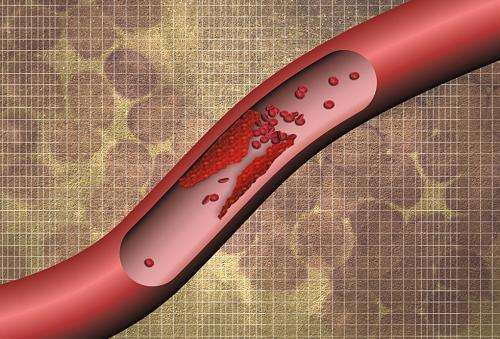 Finding blood clots before they wreak havoc