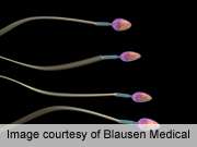 FSH, inhibin B poor predictors of sperm count after cancer