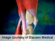 General anesthesia ups knee replacement complications