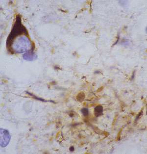 Genetic markers ID second Alzheimer's pathway