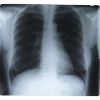 Genetic screen finds new treatment targets for lung cancer