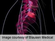 Glucosamine negatively affects lumbar discs