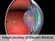 Good outcomes for resident-performed cataract surgery