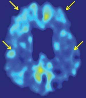 UCLA brain-imaging tool and stroke risk test help identify cognitive decline early