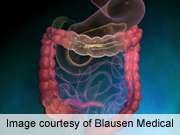 IDSA: oral ingestion viable for fecal microbiome transplant