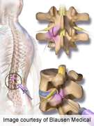 Intra-articular, systemic steroids beneficial in back pain