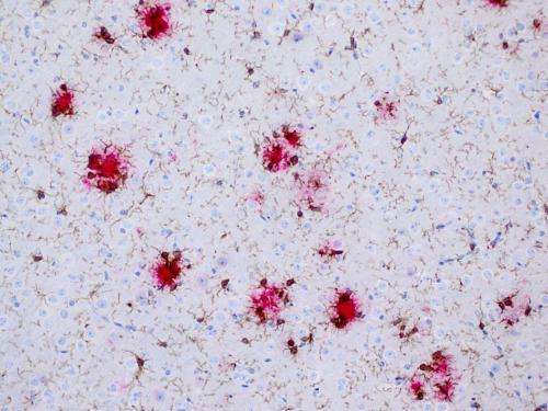 New findings on the brain's immune cells during Alzheimer's disease progression