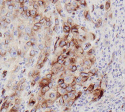 Key find for early bladder cancer treatment