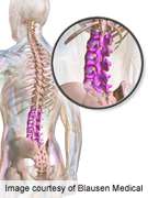 Lifestyle activities impact development of spinal stenosis