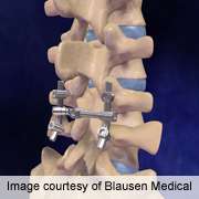 Low vitamin D levels common among spinal fusion patients