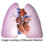 Macitentan可降低肺动脉HTN的发病率和死亡率