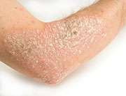 Many psoriasis patients going without treatment, study finds