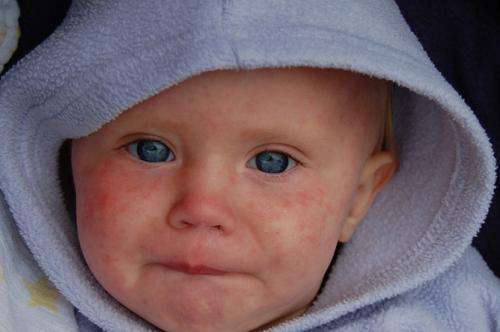 Measles: New efforts needed to stop an old disease