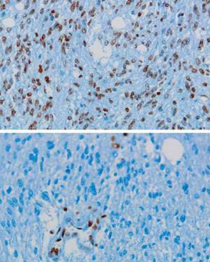 Mechanism of mutant histone protein in childhood brain cancer revealed