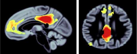 Memory-related brain network shrinks with aging