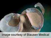 Meniscal repair failure about 23 percent after five years