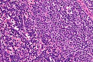 Monoclonal antibody targets, kills leukemia cells