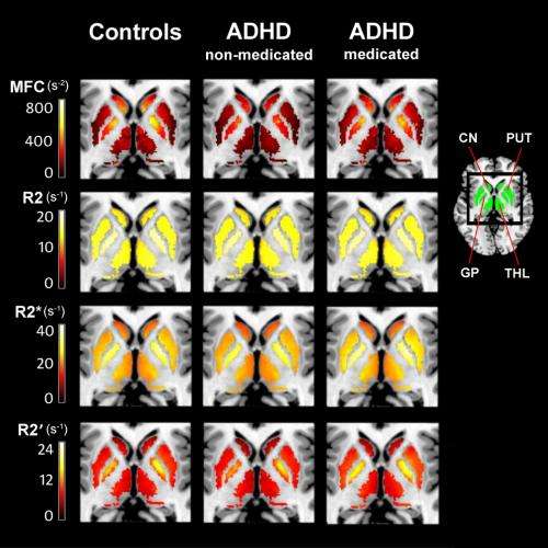 MRI technique reveals low brain iron in ADHD patients