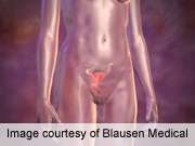 Multiple strategies are more efficient for cervical cancer