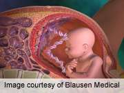 Neonatal size unaffected by gestational diabetes drugs