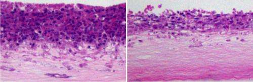 Newly identified tumor suppressor provides therapeutic target for prostate cancer