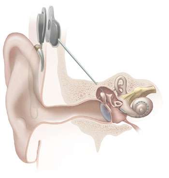 New strategy lets cochlear implant users hear music