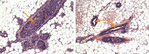 Novel noninvasive therapy prevents breast cancer formation in mice