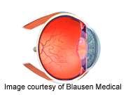 Ocular complications common after pediatric HSCT