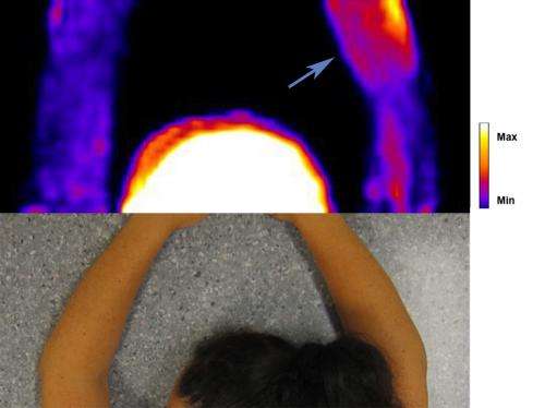 Pain processes in tennis elbow illuminated by PET scanning