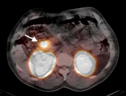 Pancreas: New procedure detects tumours more efficiently