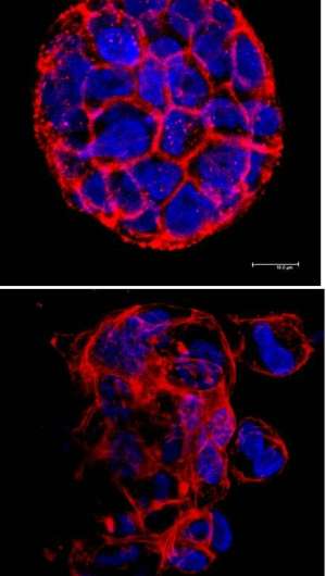 Penn study identifies new trigger for breast cancer metastasis
