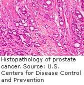 Proscar won't boost prostate cancer survival, study finds