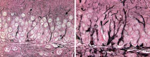 Rare disease yields clues about broader brain pathology