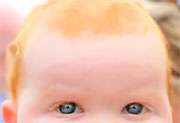 Red hair pigment might raise melanoma risk: study