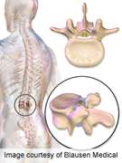 Review defines new fracture risk factors post-vertebroplasty