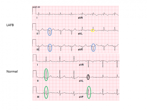 Routine EKG finding could signal serious heart problem