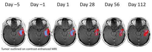 New MR analysis technique reveals brain tumor response to anti-angiogenesis therapy