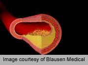 Sclerostin linked to vascular disease in type 2 diabetes