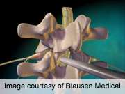 Smoker status not linked to poor outcome in spine surgery