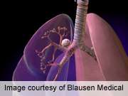 SPACE, RF ablation combo safe and effective for lung cancer
