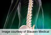 Spinal surgery helps neuro functioning in dialysis patients