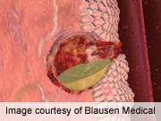 Statins may lower esophageal cancer risk