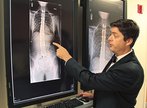 Study confirms benefit of back braces in treating scoliosis